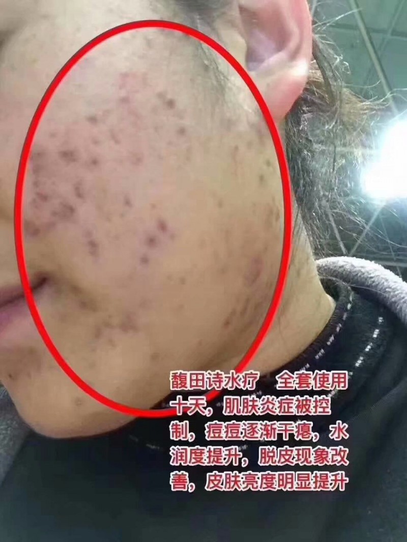 馥田詩(shī)水療，全套使用十天，肌膚炎癥被控制，痘痘逐漸干癟，水潤(rùn)度提升，脫皮現(xiàn)象改善，皮膚亮度明顯提升。